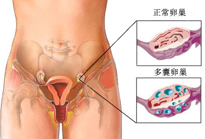 多囊卵巢分型立体