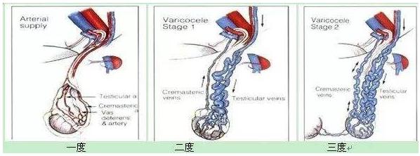 显微外科精索静脉低位结扎术