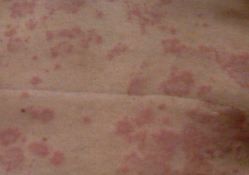 预防荨麻疹复发的几个要点