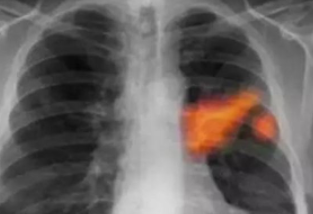 诱发肺癌的原因有哪些这点常识要知道