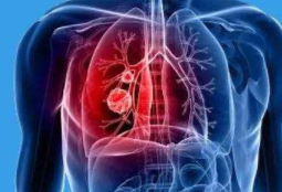 什么样的因素诱发了肺癌疾病患者须知