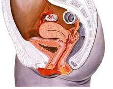 子宫内膜异位症有哪些病因