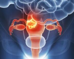 如何预防卵巢囊肿
