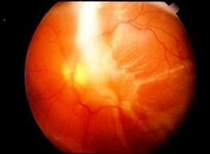 视网膜脱离发病原因有哪些
