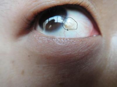 眼睛黄斑病变的症状和治疗