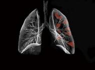 生活中要注意这5大肺癌病因
