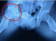 股骨头坏死的6大原因，与平常生活息息相关