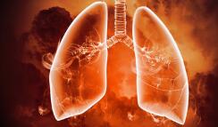 肺气肿的原因有哪些