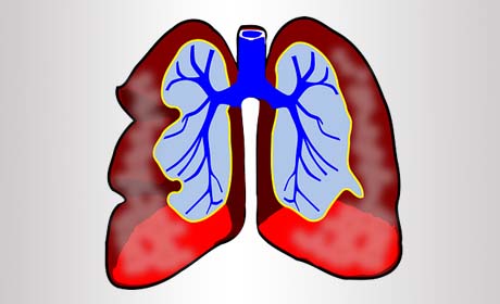 什么原因会引起肺气肿，如何护理