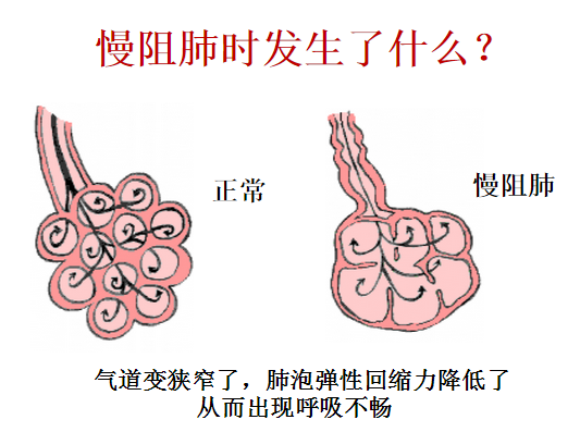 慢阻肺是什么原因导致的?与生活种的哪些因素相关