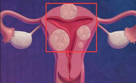 子宫腺肌症会影响试管婴儿吗?一起了解一下