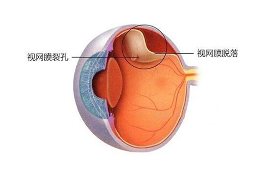 视网膜脱离的早期症状是什么
