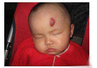 小孩子脸上有红点是怎么回事?当心是血管瘤
