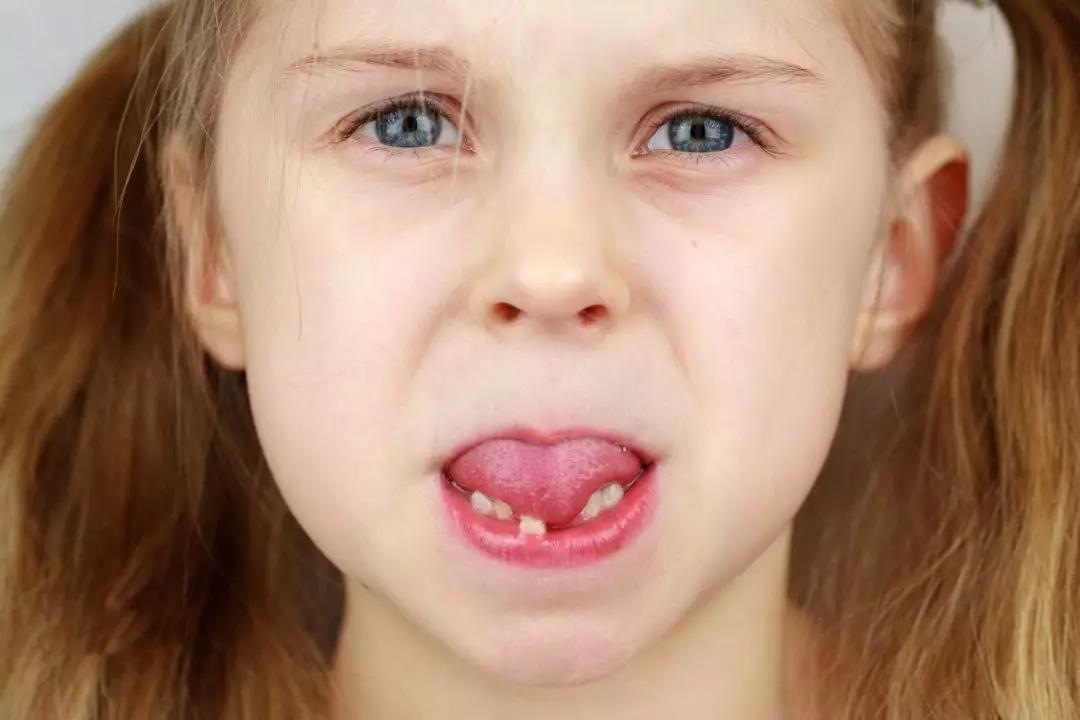 为什么国外的孩子很少蛀牙？给宝宝的牙齿穿一层“防护衣”吧！