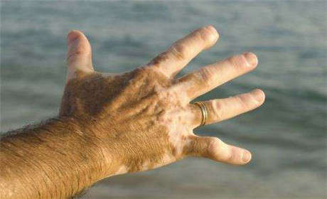 手指白癜风症状都有哪些表现?治疗困难吗?
