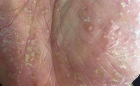 生活中掌趾脓疱病的常见诱发因素有哪些？