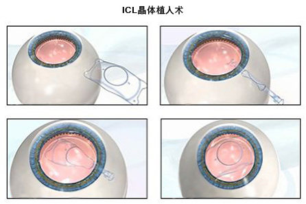 ICL人工晶体植入术矫治近视