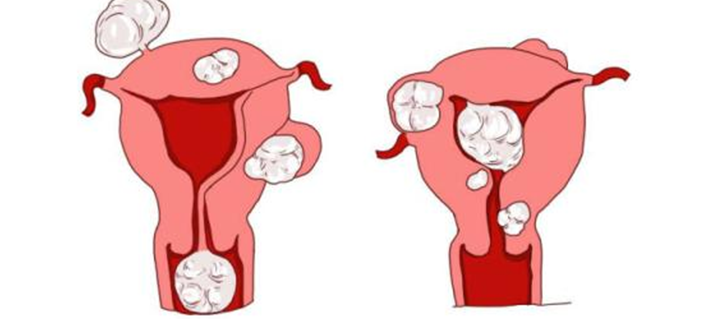 精品手术：高升医生|非脱垂子宫经阴道切除术