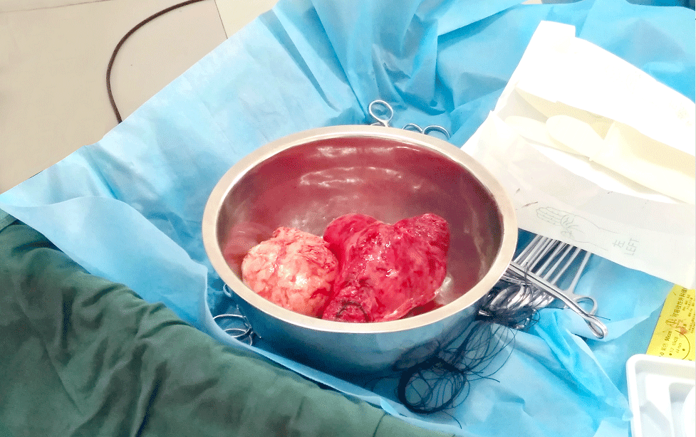 精品手术：高升医生|非脱垂子宫经阴道切除术