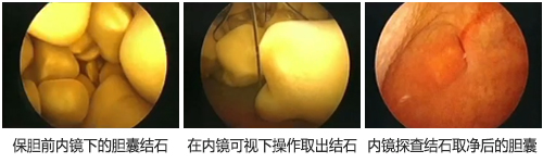 南京龙蟠结石医院超微创保胆取石术，取石不留痕，胆结石患者的治疗！