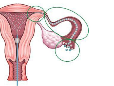 输卵管堵塞做什么检查？