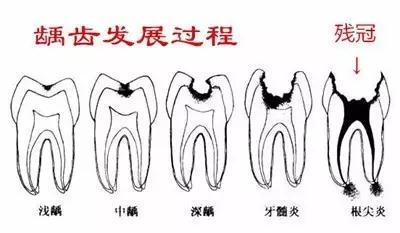 镶牙前 口腔内的残根如何处理？