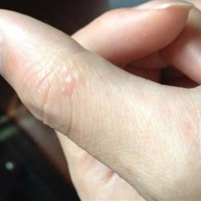 手指皮肤病的种类及症状有哪些？这些你都知道吗？
