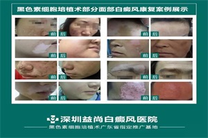 深圳白癜风医院：家长要避免白癜风孩子受外伤！
