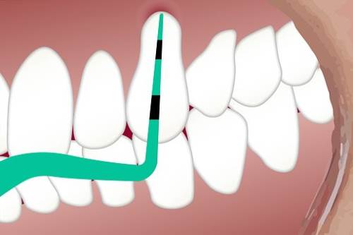 牙齿矫正的方法是什么？牙齿矫正的较佳年龄是什么时候