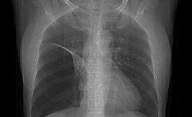 气胸有哪些危害？气胸会引发哪些并发症？一定要掌握的医学科普知识