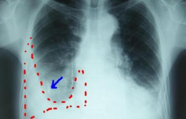 什么是胸腔积液？胸腔积液有什么危害？