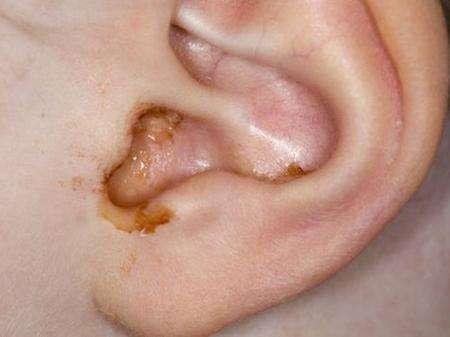 真菌性外耳道炎是什么？它的症状都有啥？