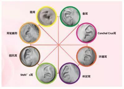 听力下降不注意？应注意传导性耳聋！