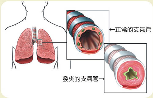 支气管炎为什么总是反复发作？生活中有哪些预防支气管炎的方式？