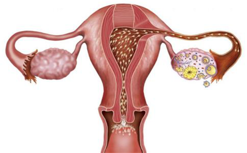 【为什么有的女性会患上多囊卵巢？】赶紧来了解一下