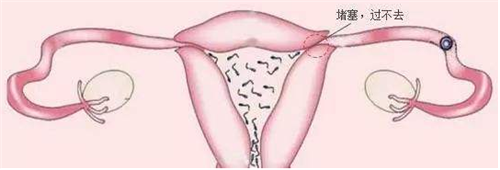【输卵管堵塞应该怎么办？】这些病因你知道吗？