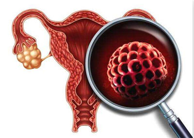 多囊卵巢如何有效的治疗？患者应该了解！