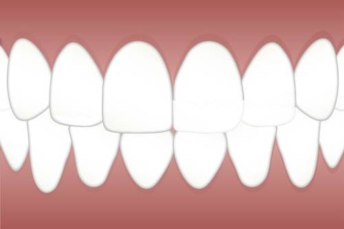 美白牙齿的方法你知道多少?一起了解一下