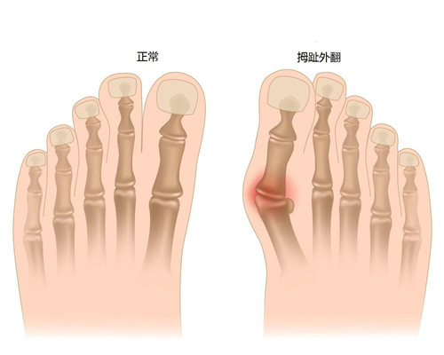 拇指外翻怎么去治疗，应该去哪里治疗呢？一定要了解