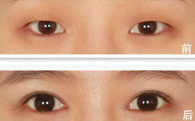 不同的眼型的开眼角方法以及术后应该怎么护理？