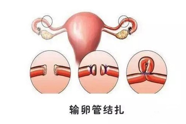 输卵管解扎多久可以怀孕