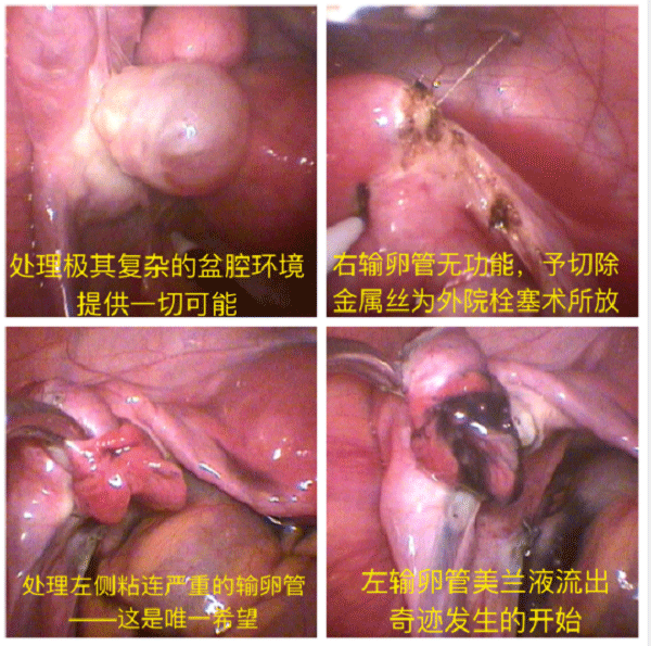 6次试管婴儿失败，较终在黑龙江虹桥医院喜得好“孕”