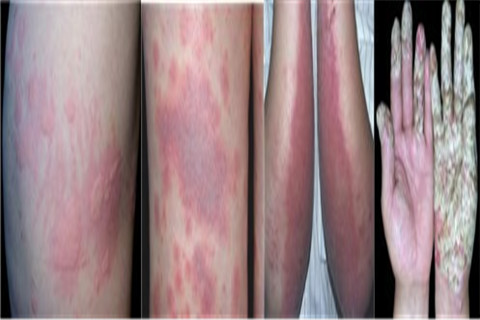 皮肤过敏：长期皮肤过敏会给身体带来哪些影响？