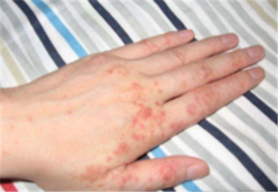 湿疹患者日常的行为举止，都要注意什么？