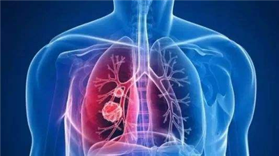 肺疾病患者做完手术了，术后如何护理？