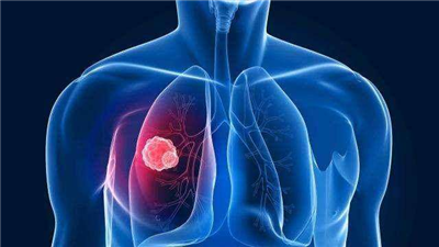 你对肺癌了解多少？这些可能你从来没听说过！