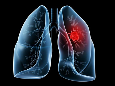 你对肺疾病了解多少？这些可能你从来没听说过！