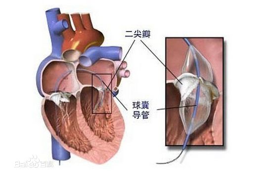 二尖瓣狭窄的详细科普，你想知道的这里都有哦！