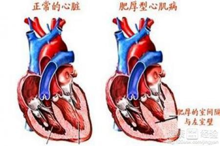 不同类型的心肌病的治疗方法不同，这些你听说过吗？