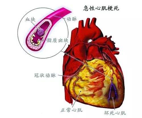 心肌梗塞的症状表现，你以为年轻人就不会得吗？